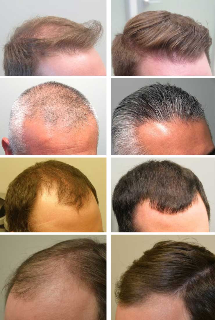 Finasteride before and after Riverside, CA