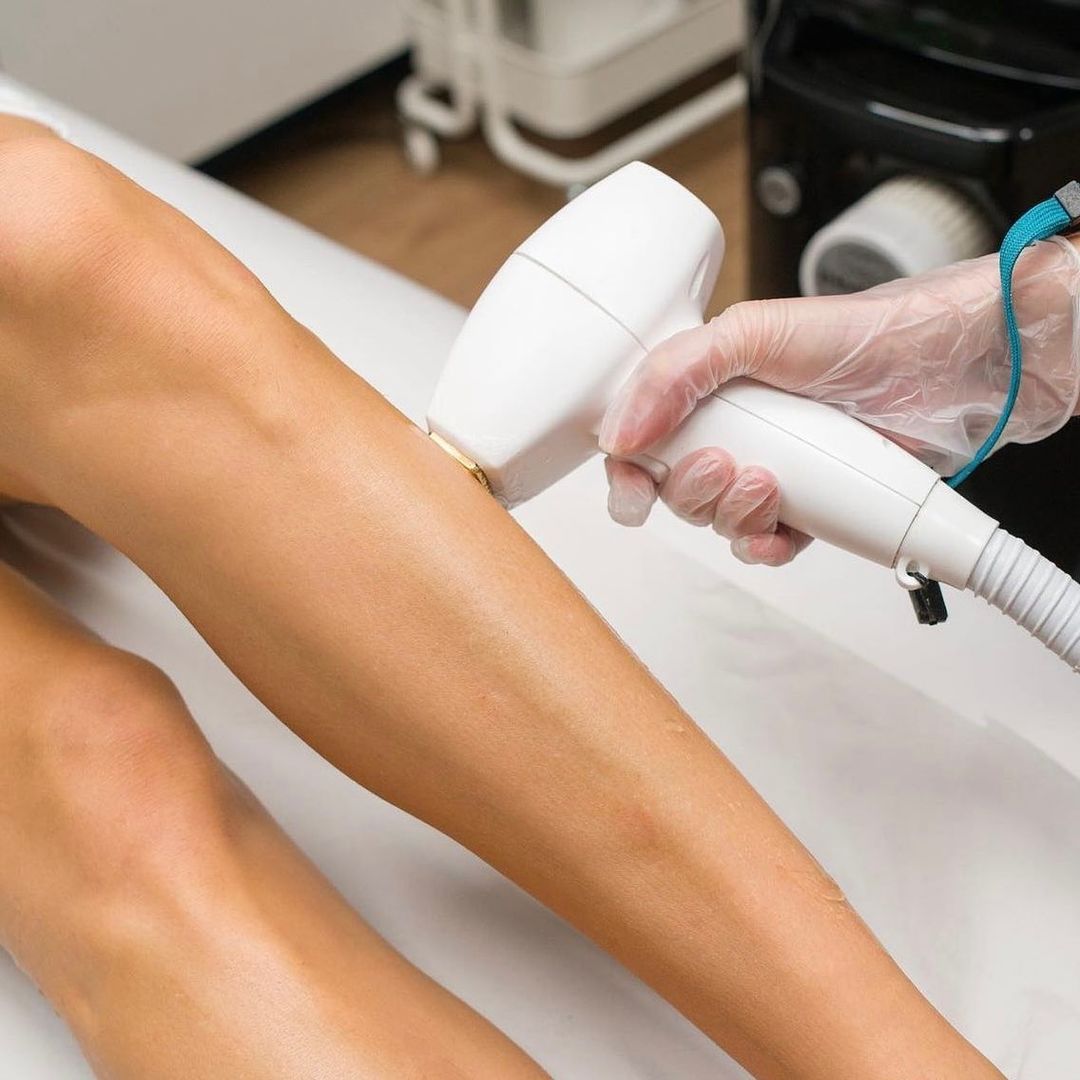 laser hair removal legs corona ca
