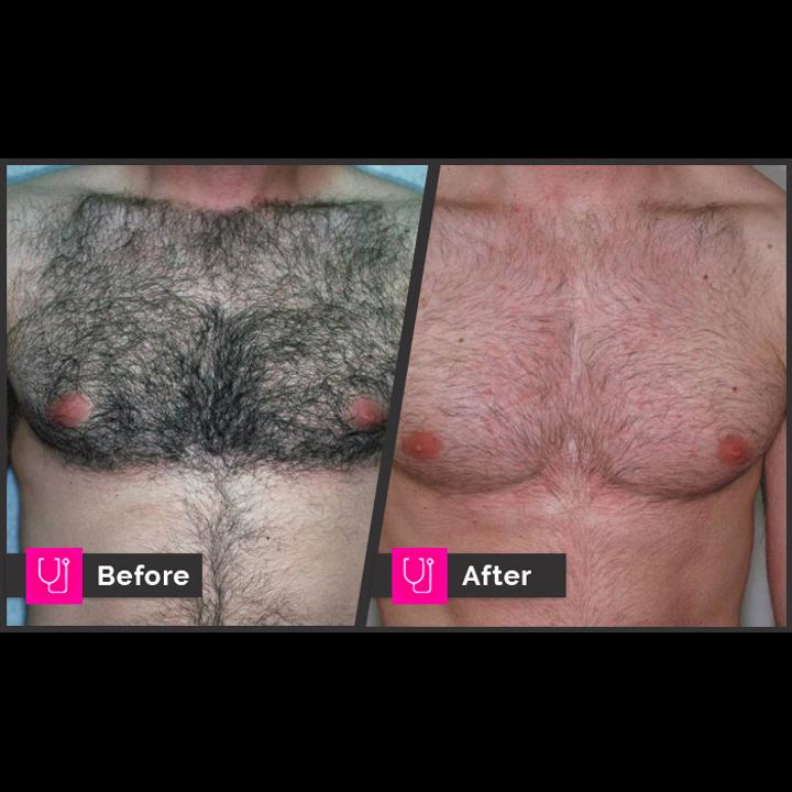 before-after-laser-hair-removal04