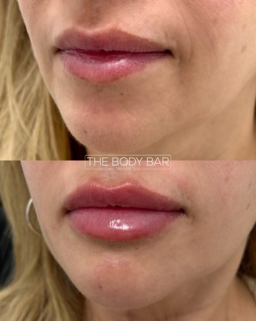 Lip fillers before and after by the body bar medical spa in corona ca female model patient 11